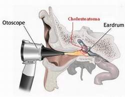 Cẩn trọng trong điều trị viêm tai giữa mạn tính có cholesteatoma